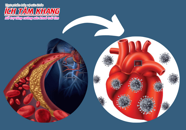 Vi khuẩn theo mạch máu vào tim gây ra bệnh viêm nội tâm mạc 